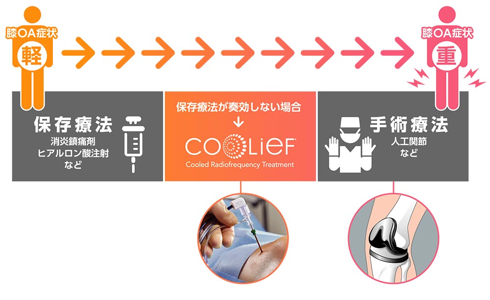 ラジオ波焼灼療法（Coolief* 疼痛管理用高周波システム）のイメージ画像3