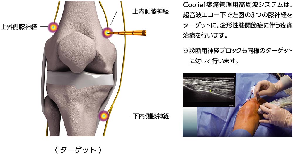 ラジオ波焼灼療法（Coolief* 疼痛管理用高周波システム）のイメージ画像3