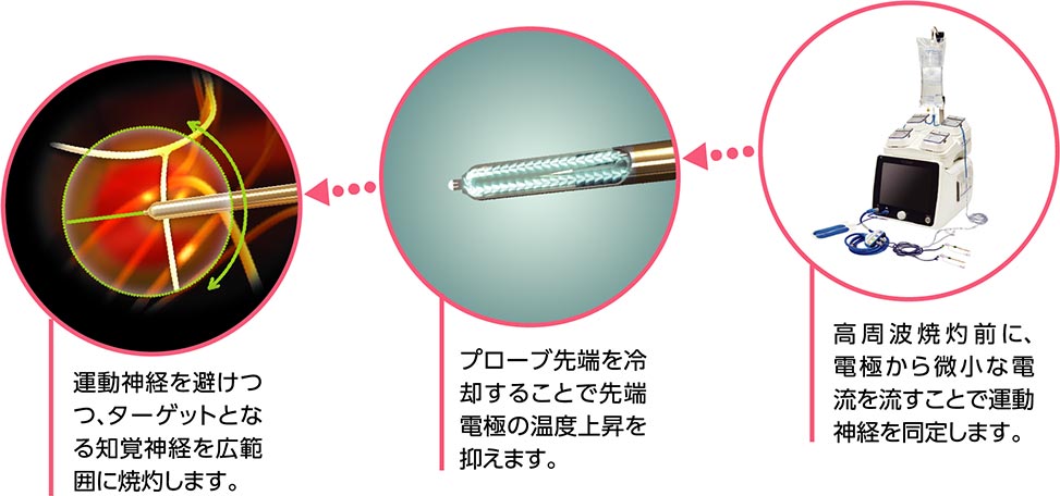 ラジオ波焼灼療法（Coolief* 疼痛管理用高周波システム）のイメージ画像4