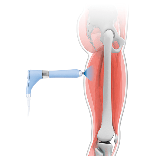 体外衝撃波治療のイメージ画像